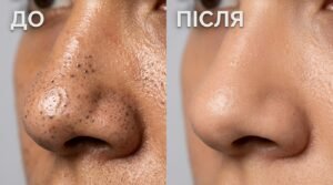 Як позбутися чорних крапок на носі назавжди