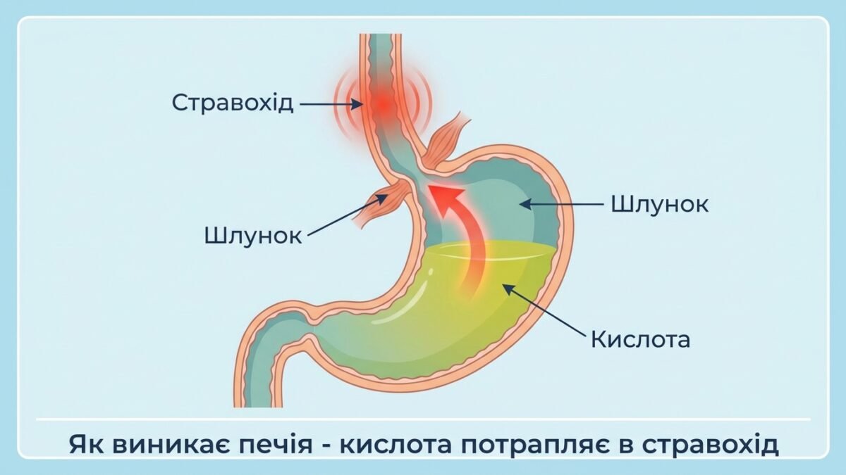 Що робити при печії: 12 швидких домашніх способів, які реально допомагають