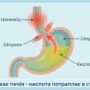 Що робити при печії: 12 швидких домашніх способів, які реально допомагають